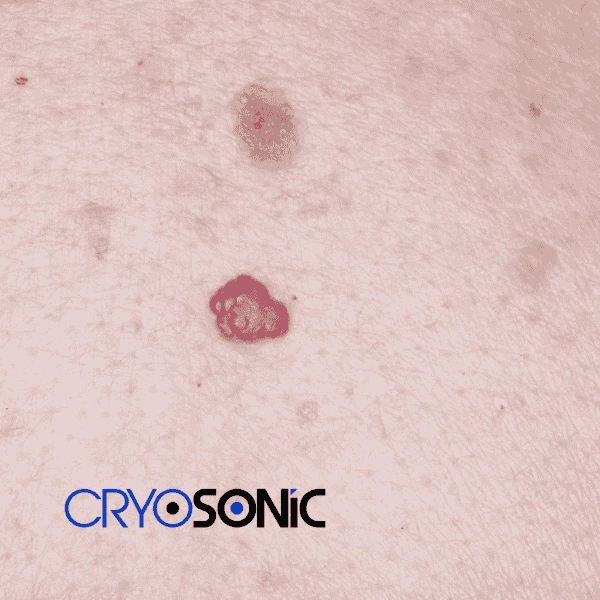 Looking for pain free cherry angioma removal treatment Swindon? Call our team today! Swindon