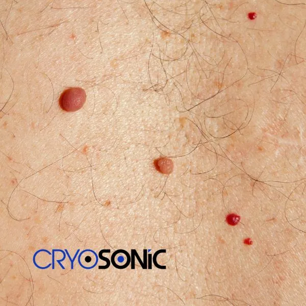 get cherry angioma removal treatment today! Swindon