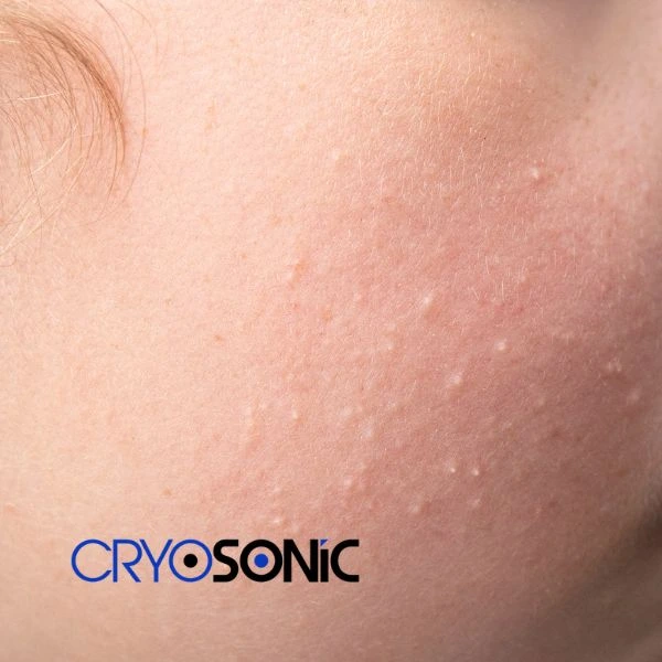 Are you looking for milia removal treatment? Contact our team today Swindon