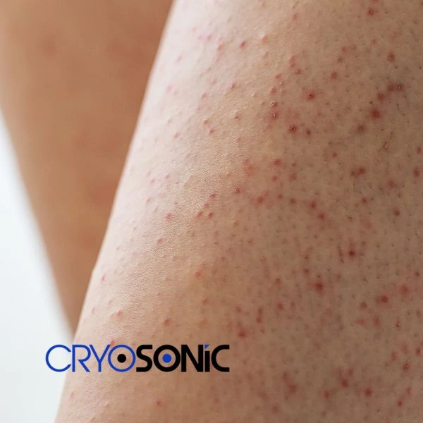 Looking for Seborrhoeic Keratosis removal Swindon treatment? Call our consultants today in Swindon