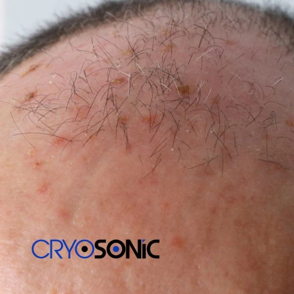 Access Seborrhoeic Keratosis removal from the comfort of your own home! Call us today in Swindon