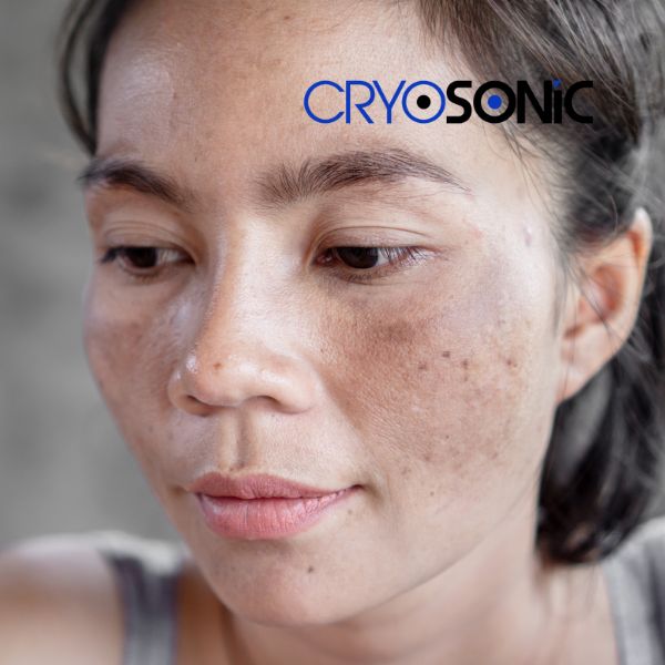Ready to start age spots removal? Contact our team today in Swindon