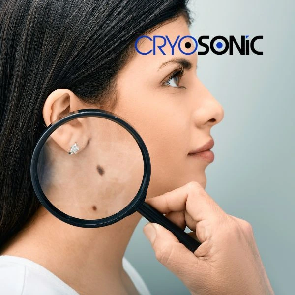 Do you want to learn more about benign moles removal treatment? Call our team today Swindon