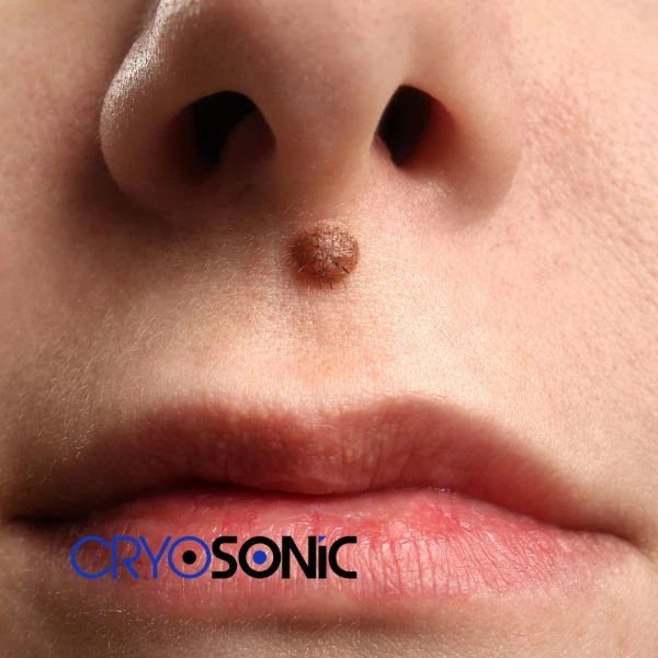 Start your benign moles removal treatment today Swindon