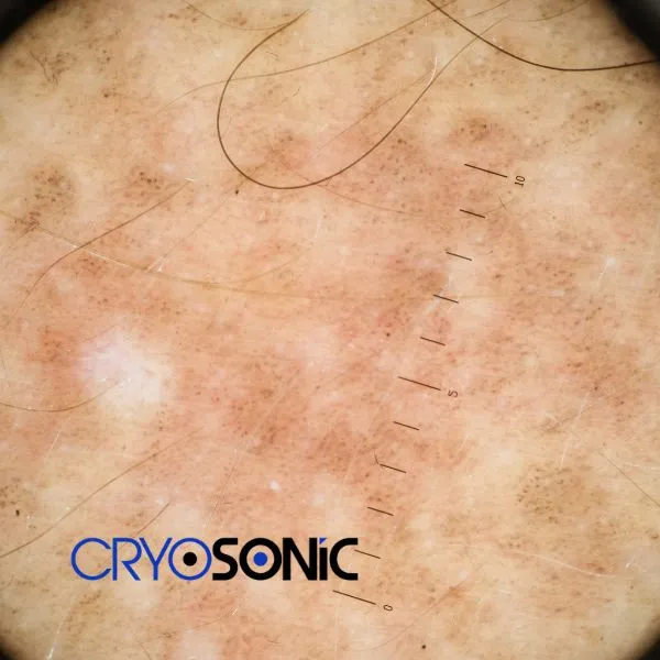 Speak to our team today about sun damaged skin treatment today in Swindon