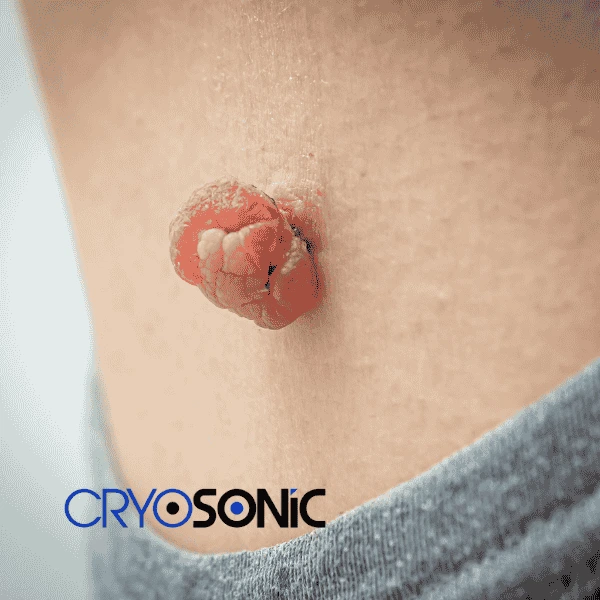 Book your skin tags removal Swindon from comfort of your own home! Swindon