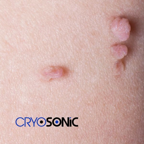 Are you looking for fast effect skin tag removal Swindon? Book in NOW! Swindon