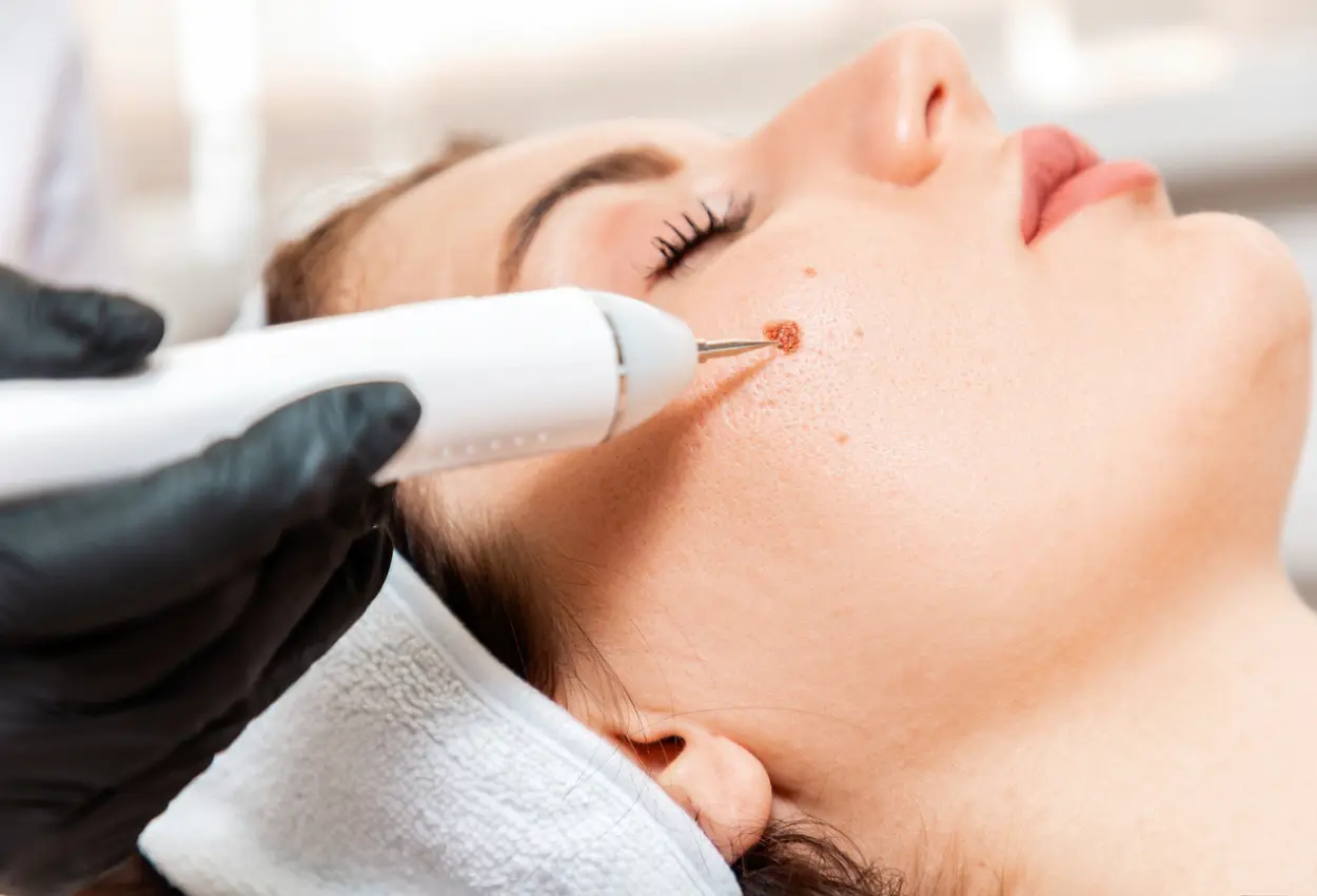 Frequently Asked Questions About Multiple Cryotherapy Treatments Swindon
