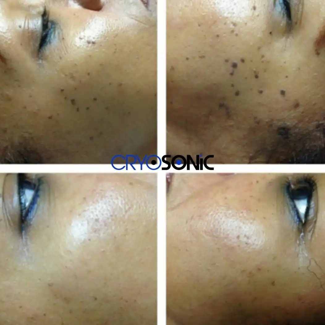 Why Skin Shows Pigmentation After Treatment Swindon