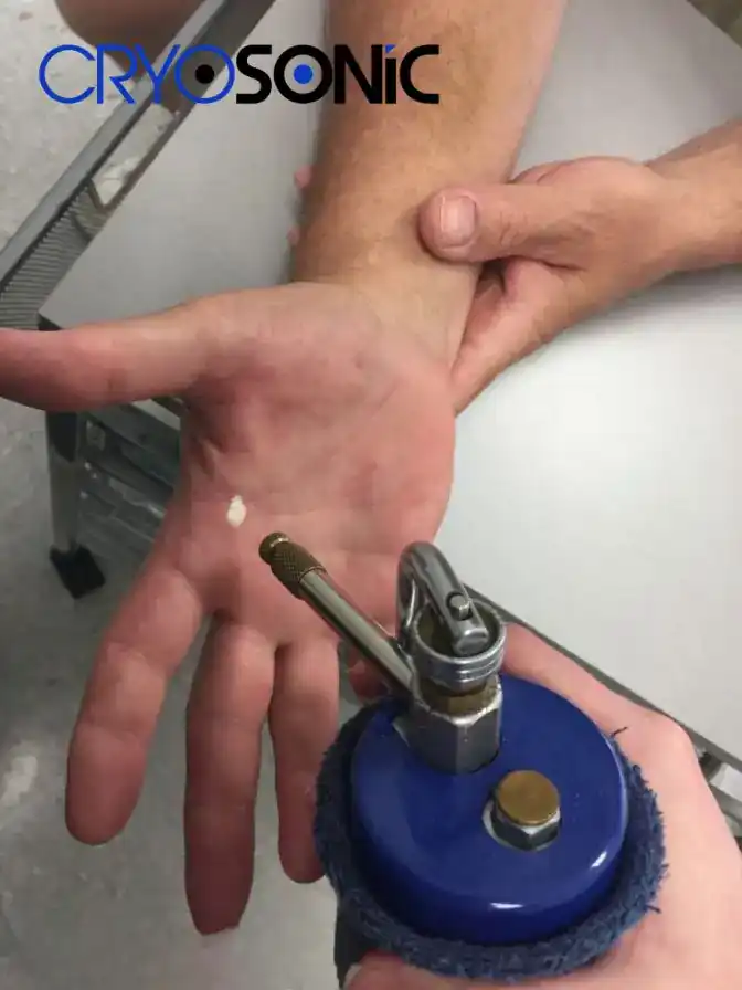 Temperature Differences: OTC vs Medical-Grade Cryotherapy Swindon